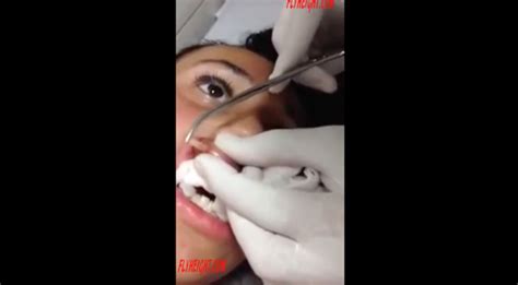 Woman has huge bot fly larvae removed from her lip (video) - AOL