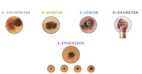 Melanoma Symptoms and Detection