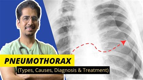 PNEUMOTHORAX- Types, Causes, Diagnosis & Treatment || Detailed video ...