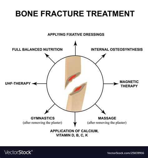 Treatment bone fractures fracture Royalty Free Vector Image