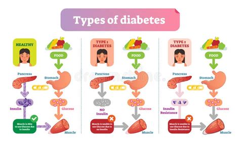 Diabetes Types Diagram