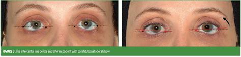 Use of Hyaluronic Acid Fillers to Correct Scleral Show: A Review of Technique : JCAD | The ...