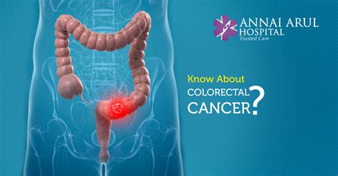 KNOW ABOUT COLORECTAL CANCER? – Multispeciality Hospitals in Chennai