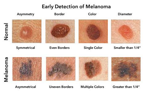 Melanoma - TamaryneAshley