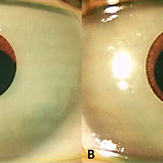 Cosmetic iris implants located in the anterior chamber with iris... | Download Scientific Diagram