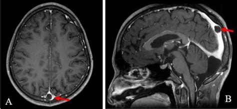 Giant arachnoid granulation: (A) Axial and (B) sagittal post-contrast... | Download Scientific ...