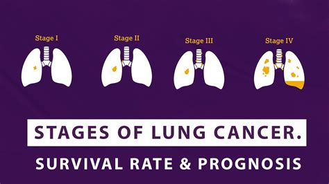 Stages Of Lung Cancer – Survival Rate And Prognosis - Macs Blogs