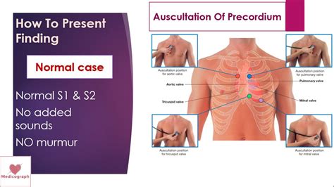 auscultation of precordium | examination of #precordium part 3 ( auscultation