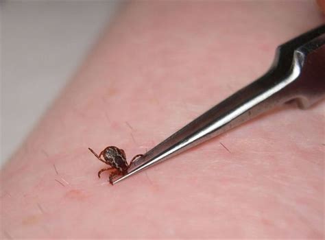 Tick removal — 5 simple steps — Mosi-guard