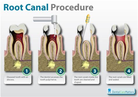 root-canals - Smiles Dental Docs Moncton