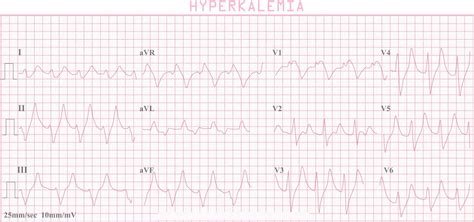 Hyperkalemia causes, signs, symptoms, ECG changes and treatment