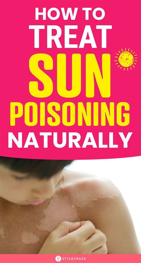 Sun poisoning treatment – Artofit