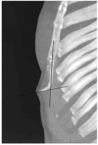 Ultrasound-Guided Injection Technique for Xiphisternal Joint Pain | Anesthesia Key