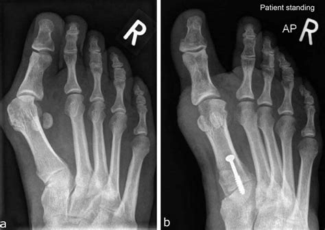 Hallux valgus deformity causes, hallux valgus bunion & treatment