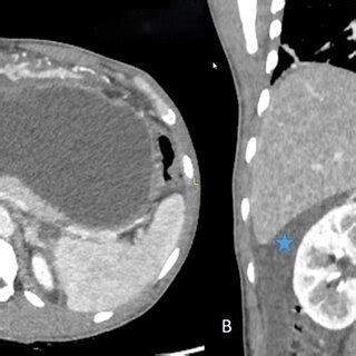 Hemoperitoneum. Contrast-enhanced coronal ( ) and axial ( ) CT scan in... | Download Scientific ...