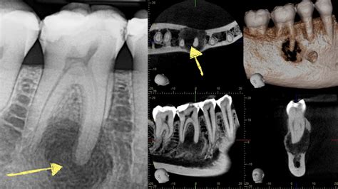 periapical jaw tooth bony cyst lesion infection kazemi oral surgery 1 ...