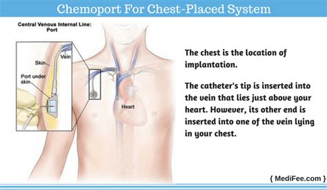 Chemo Port Procedure