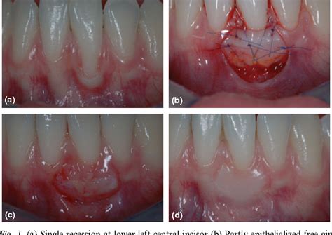 Mucogingival Junction | Semantic Scholar