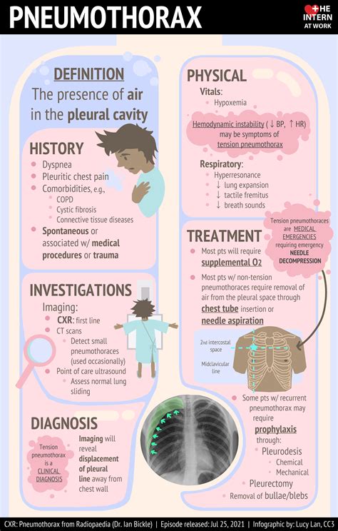 Approach to Pneumothorax — The Intern at Work