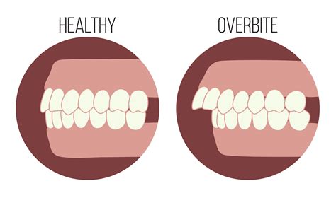 Overbite or "Buck Teeth": THE STEPS TO THE SMILE YOU'VE ALWAYS WANTED ...