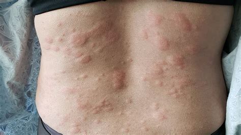 Hives Symptoms: What They Look Like