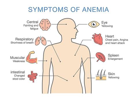 Anemia; 13 Warning Signs & Symptoms of Anemia - Page 13 of 13 - Left ...