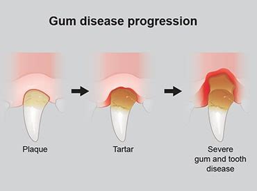 What Does Gingivitis Look Like In Dogs