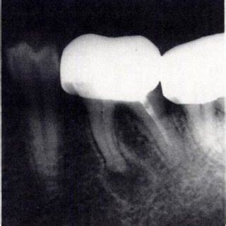 Periapical Abscess Radiograph