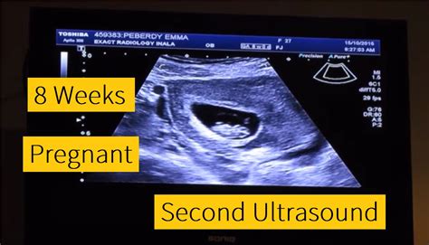 8 Week Ultrasound Photo