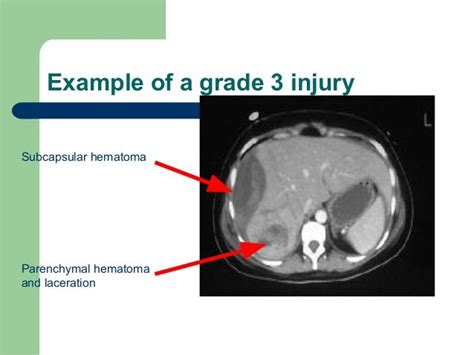 Liver Trauma