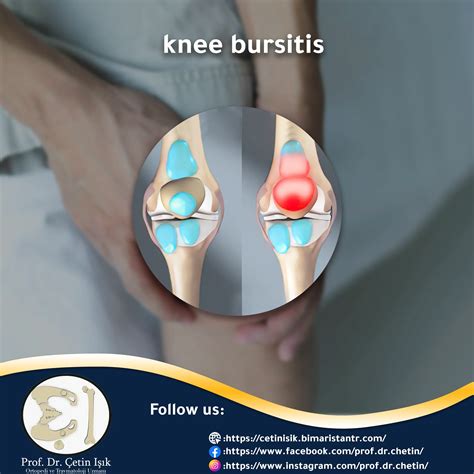 Knee bursitis and everything related to it - Dr. What's wrong with you?