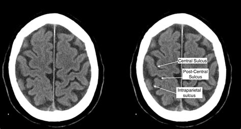 Intraparietal Sulcus Function