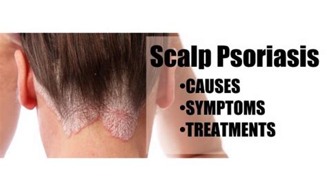 what causes scalp psoriasis - pictures, photos