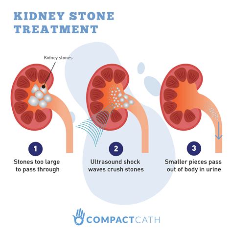 Urinary Incontinence_kidney stone treatment - CompactCath