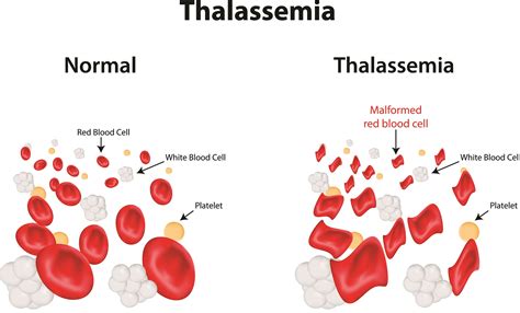 Thalassemia Genetics And Pregnancy | The Classification Of Thalassemia