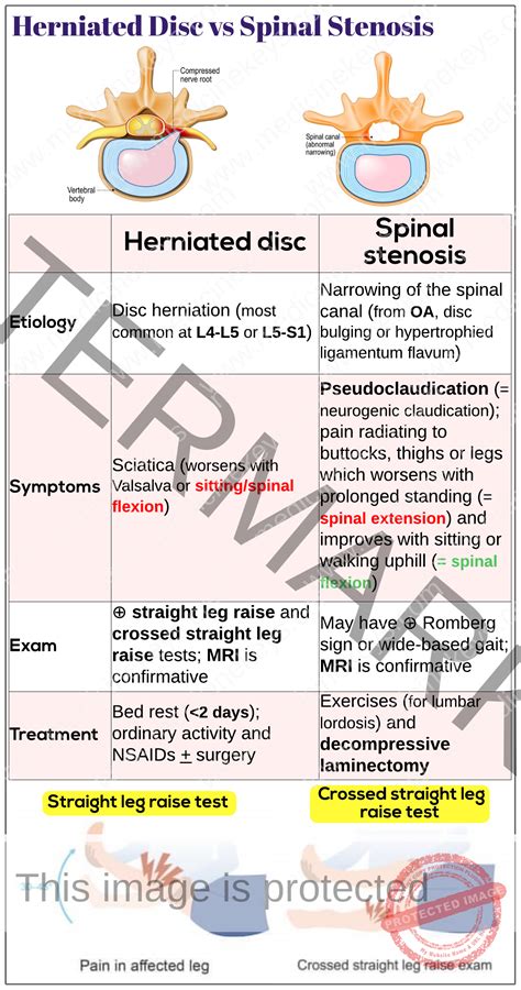 Herniated disc vs spinal stenosis - Medicine Keys for MRCPs