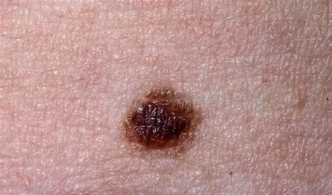 Nevus - Dermatology - Medbullets Step 1