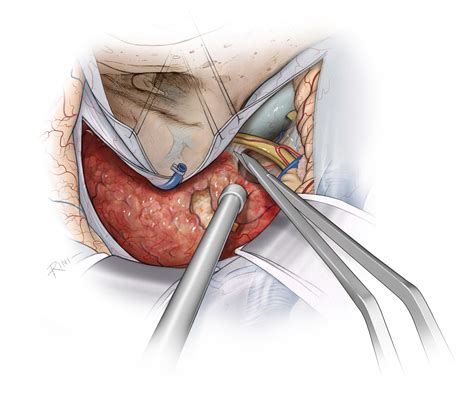 Petroclival Meningioma: Posterior Petrosal Approach | The Neurosurgical Atlas