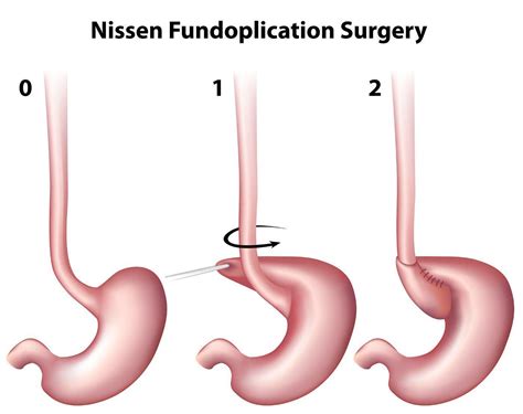 Fundoplication Specialist - Dallas, Plano, & Tyler, TX: Center for Advanced Surgery: Gastro ...