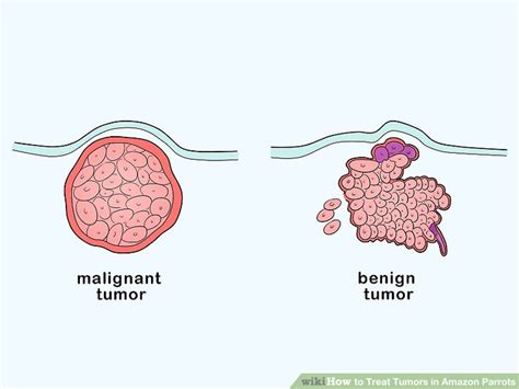 Benign Tumor