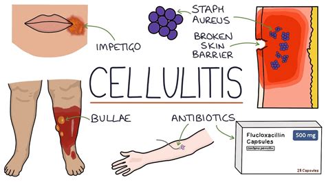 Cellulitis Causes