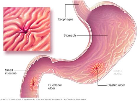 Peptic ulcer - Symptoms and causes - Mayo Clinic