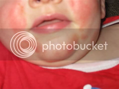 Is this a teething rash? | BabyCenter