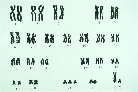 Types of Trisomy: Causes and Symptoms