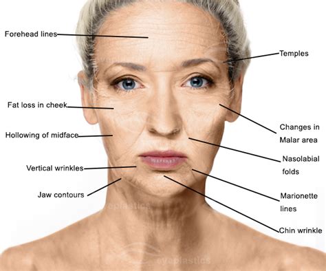 Face Lift Surgery| Facelift | Mid-Face Lift | cheek lift