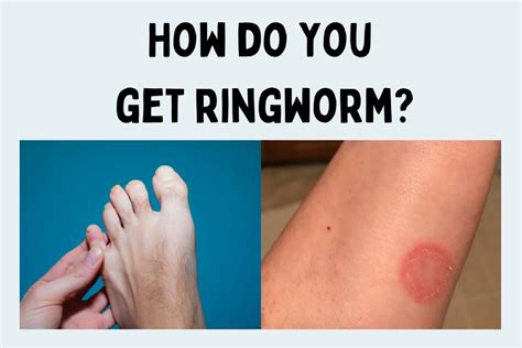 How Ringworm Spreads, and What Causes It?