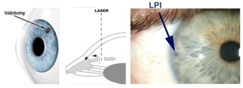 Narrow angles - Neuro-Ophthalmology