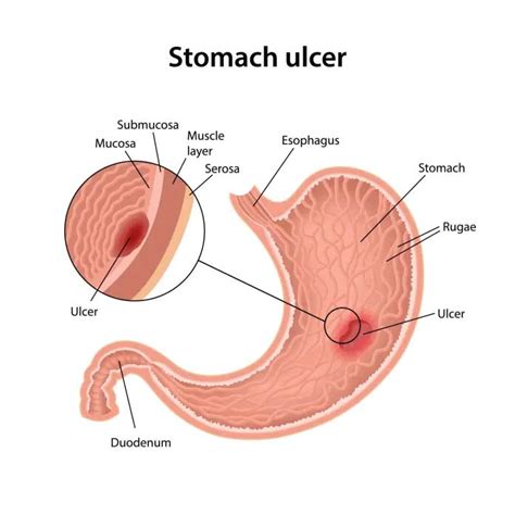 What are Stomach Ulcers? | Stomach Ulcer Symptoms, Causes, Treatmen