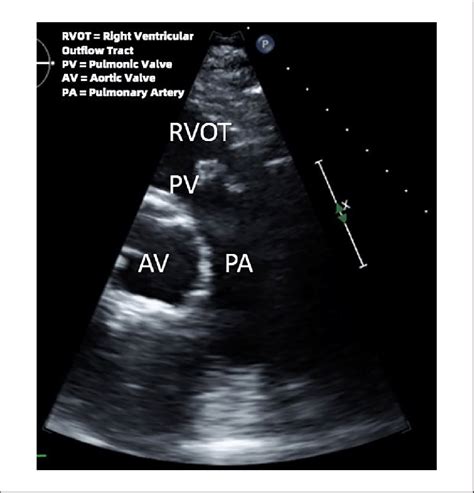 Transthoracic echocardiography showing vegetation attached to the... | Download Scientific Diagram