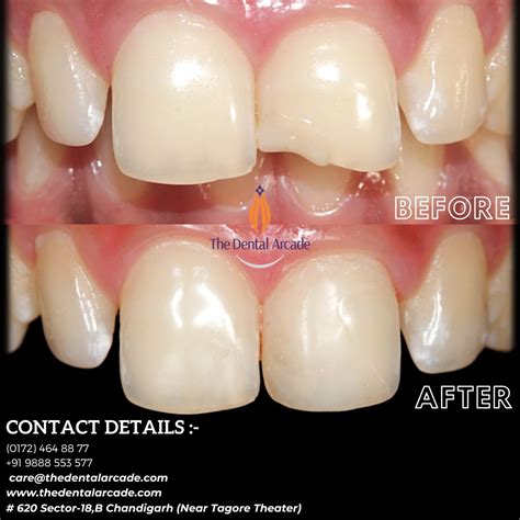 Composite restoration | The Dental Arcade – Blog